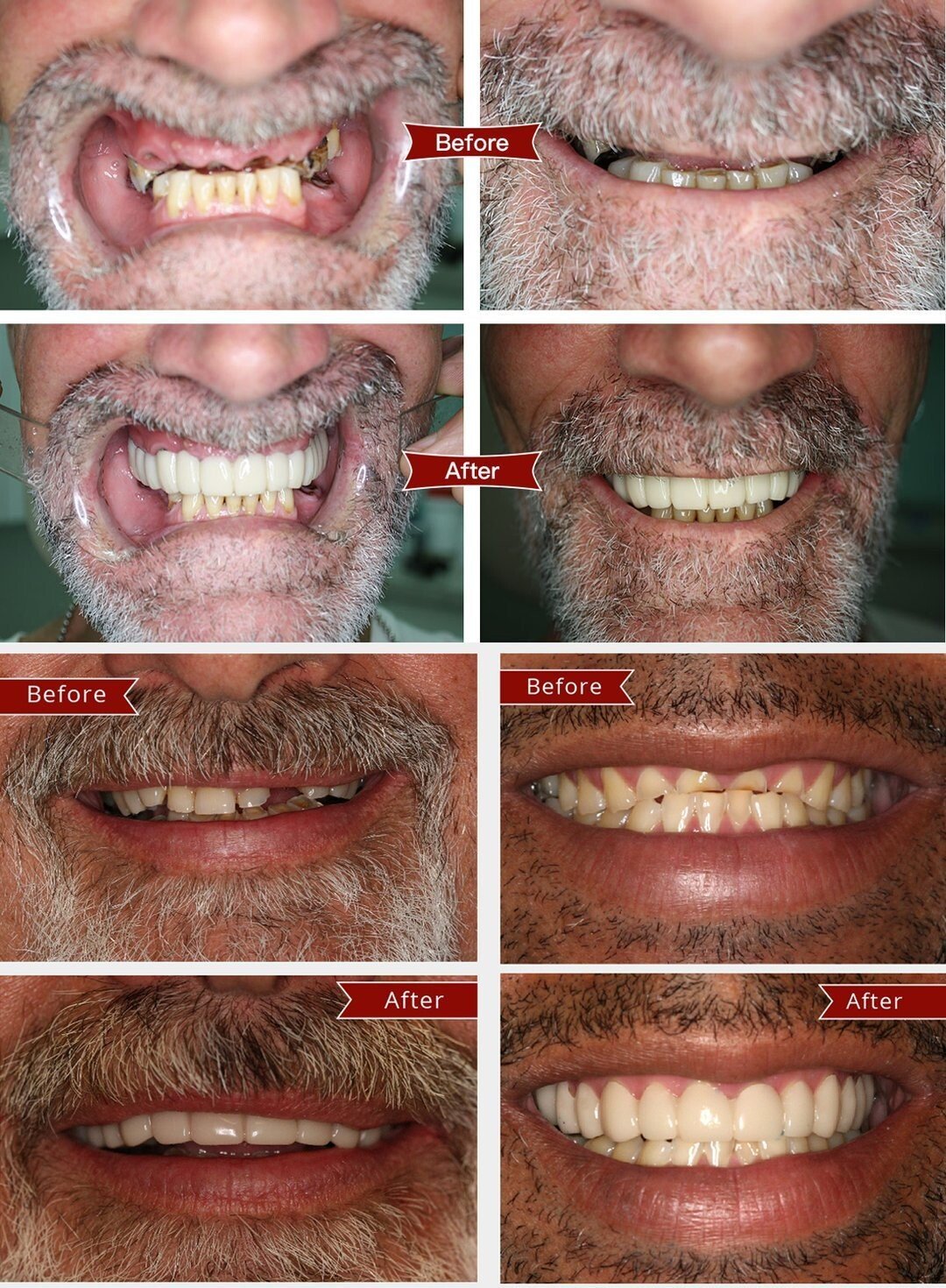 Latest👨‍⚕Adjustable Snap-On Dentures😁 (💥50% OFF) - 🔥HOT SALE🔥🎉